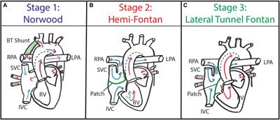 Interventional Planning for Endovascular Revision of a Lateral Tunnel Fontan: A Patient-Specific Computational Analysis